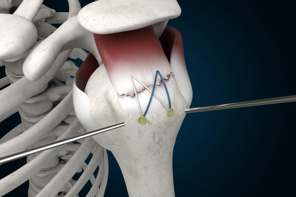 Rotator Cuff Repair
